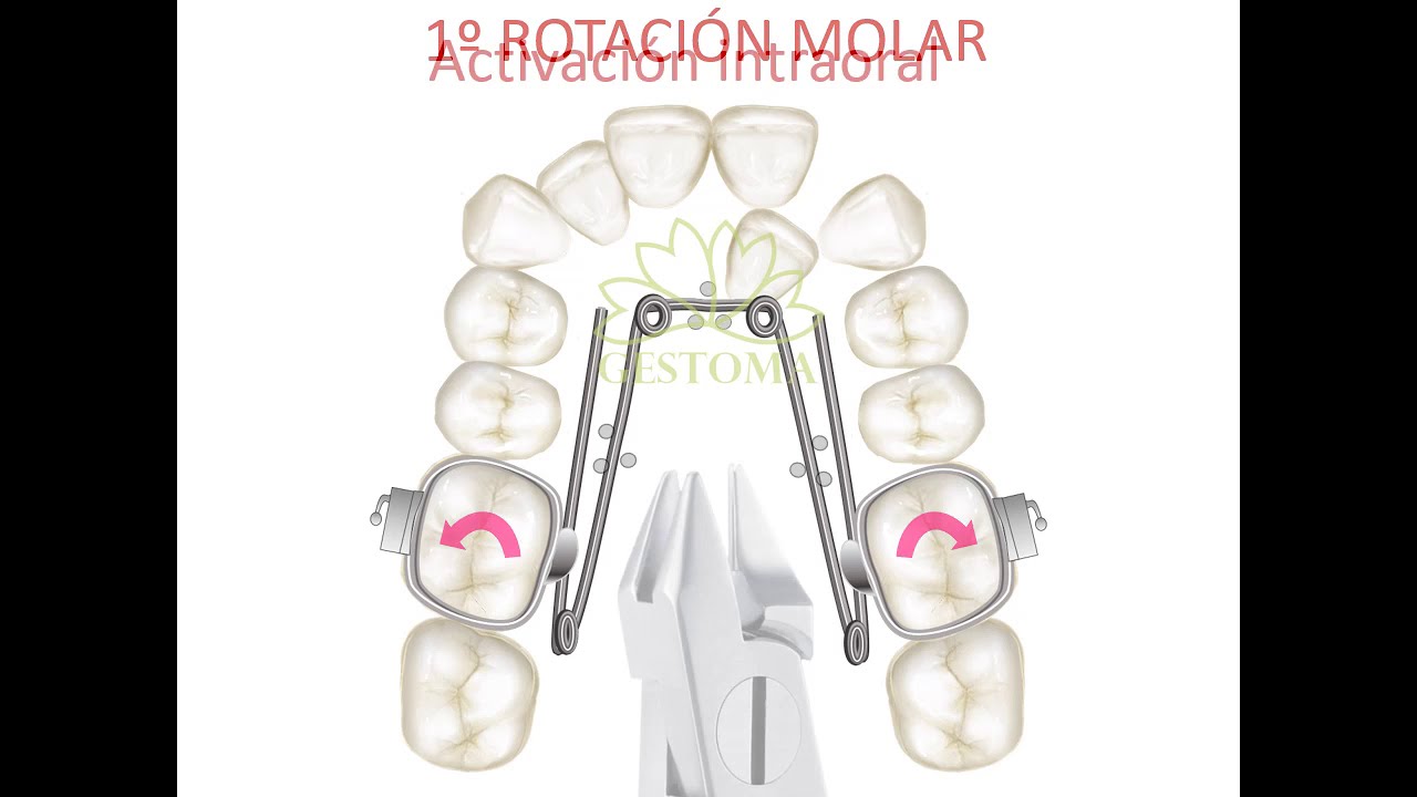 Manejo Quad Helix en Ortodoncia Gestoma