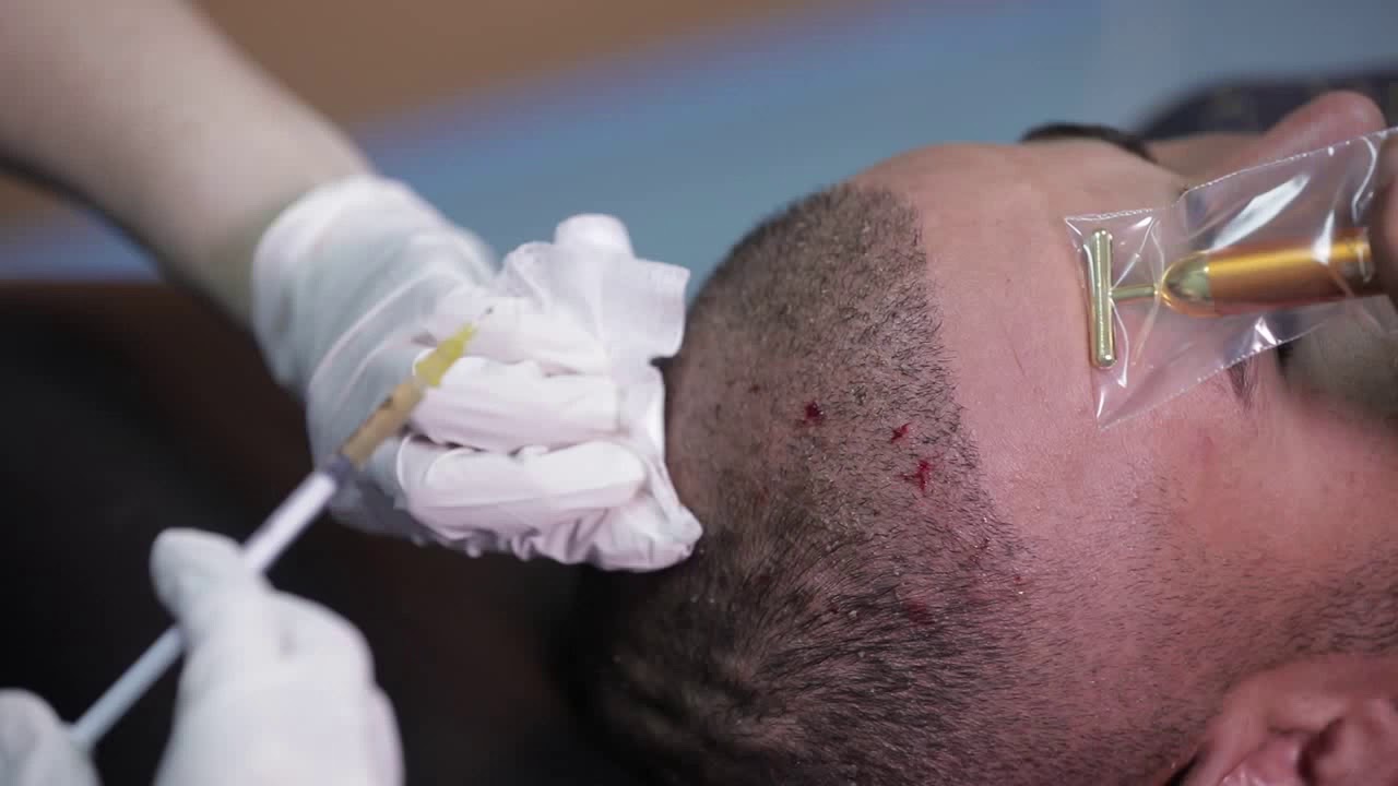 حصة بلازما بعد زراعة الشعر | زراعة الشعر في تونس | الدكتورة بية بوريشة