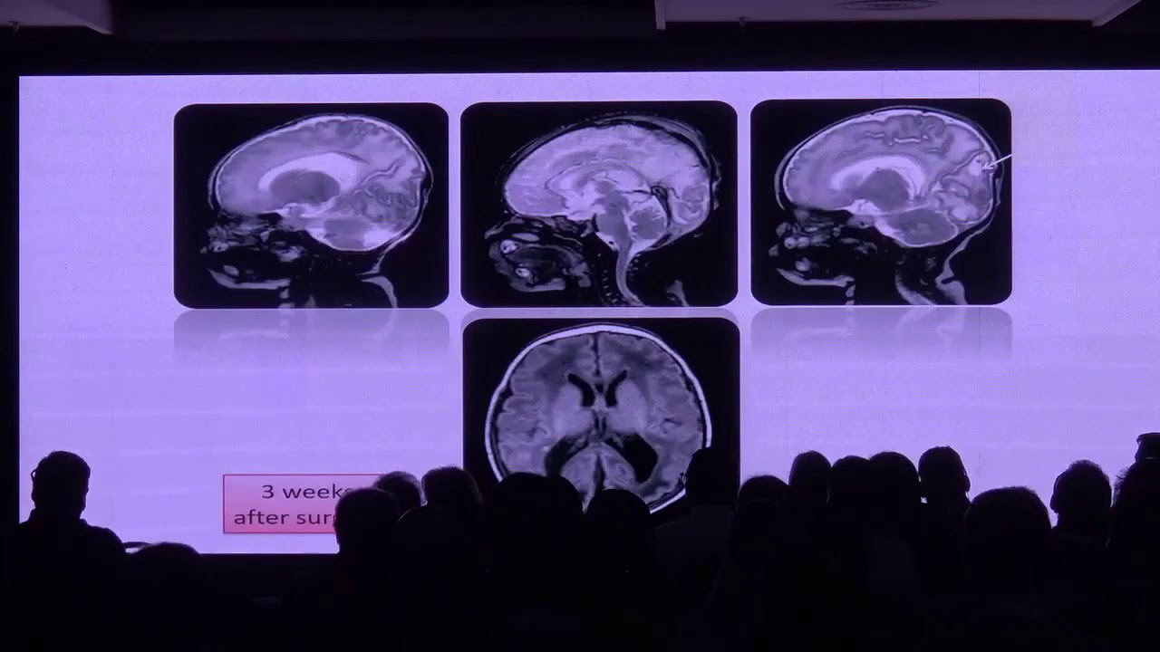¿Cómo esclarecer la ventriculomegalia “aislada”? Laurent Guibaud