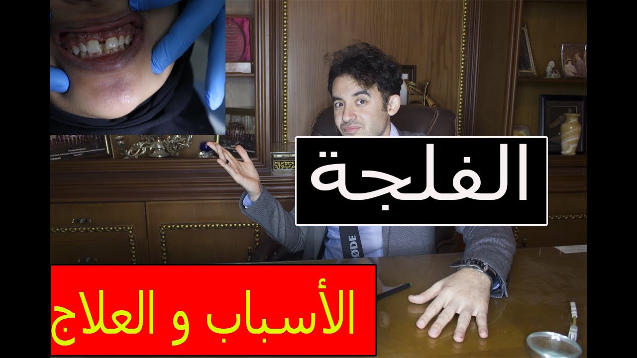 الفلجة أو تباعد الأسنان Diastema  الأسباب  وطرق العلاج مش هتتحير تانى بعد الفيديو دة الزلوعى