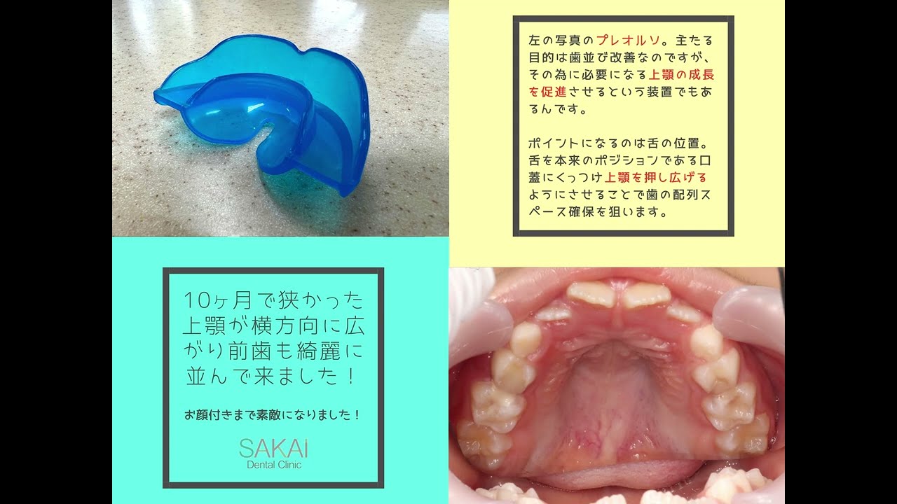 【小児マウスピース矯正】プレオルソで&ldquo;上顎の成長&rdquo;を促す仕組みとは？｜いわき市 酒井歯科医院