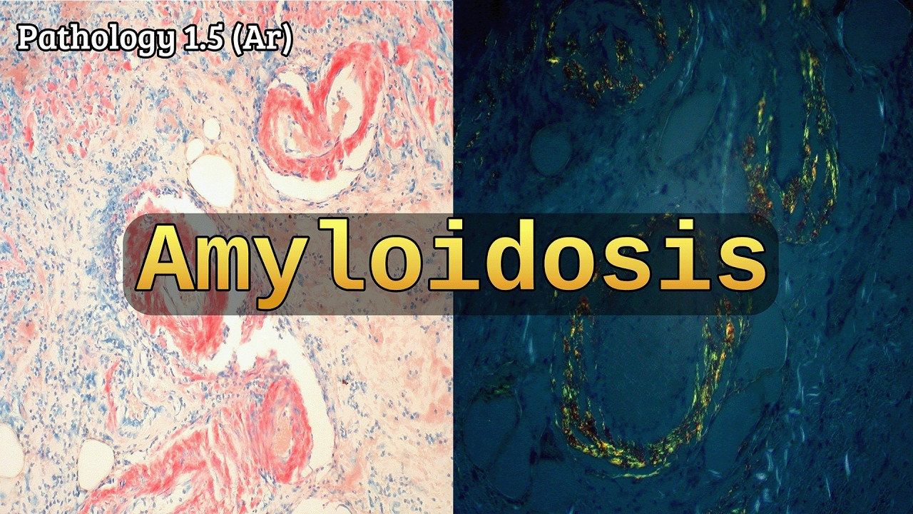 Amyloidosis 🧬 باثولوجي بالعربي شرح