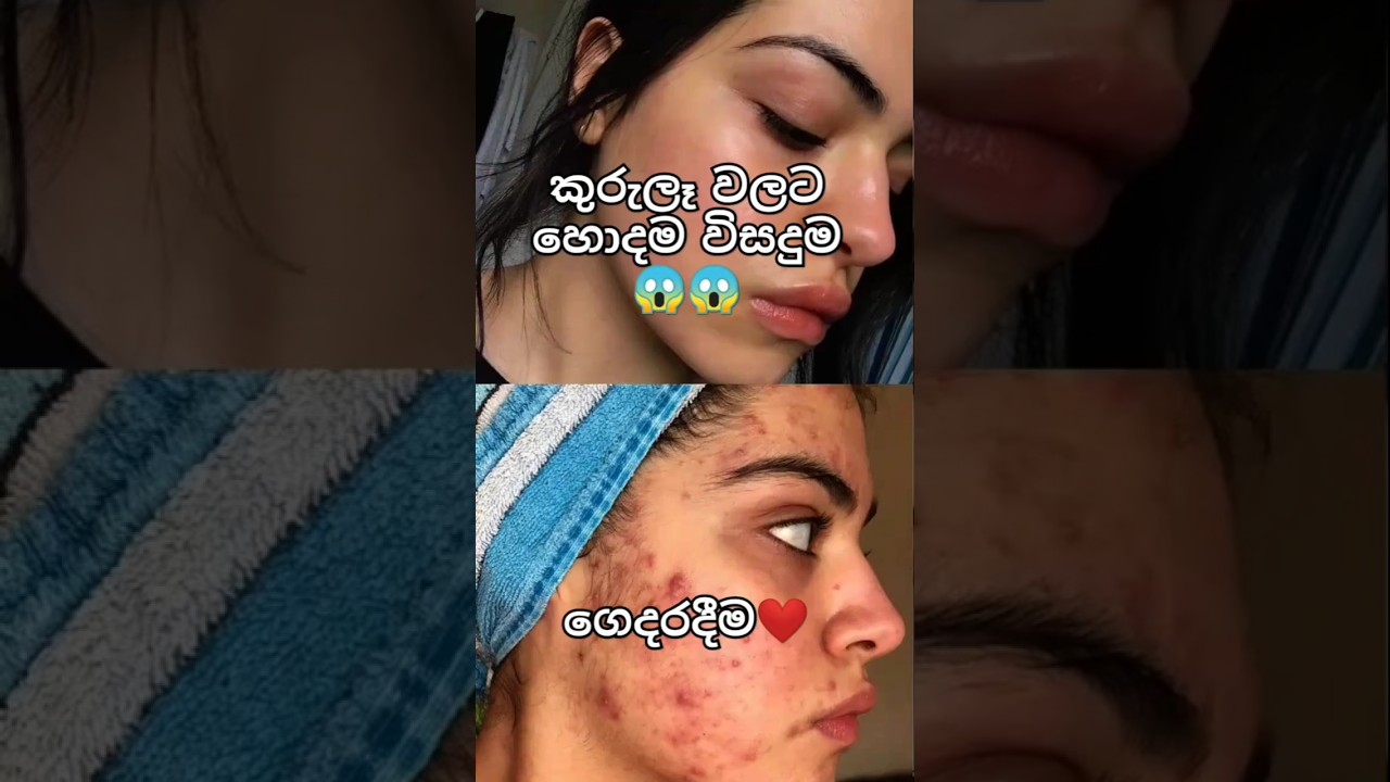 Ice cube treatment  in sinhala❤🌸#vlog #beauty #skincare