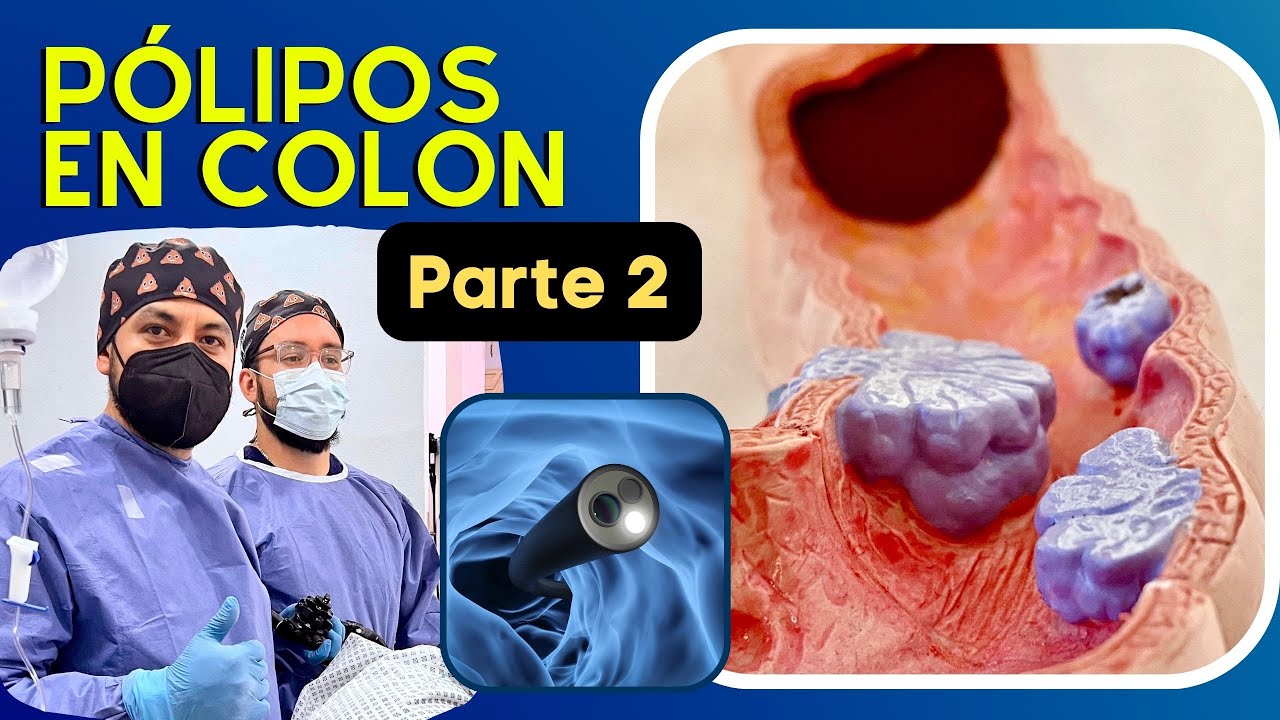 Síntomas, Diagnostico y Tratamiento de los Pólipos en Colon | Parte 2 | Dr Juan Pablo Hernández