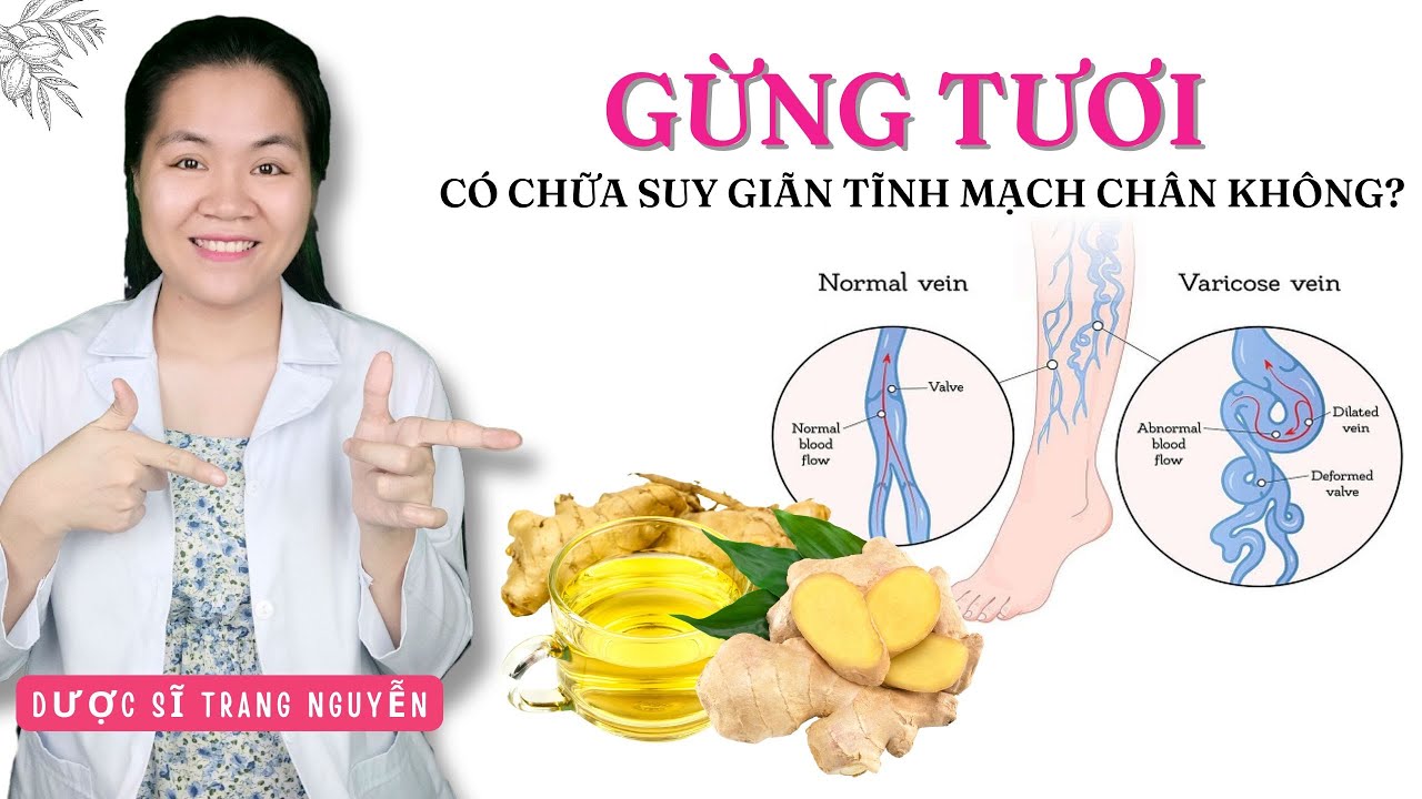 Sử dụng gừng tươi chữa suy gi&atilde;n tĩnh mạch như thế n&agrave;o l&agrave; hiệu quả?