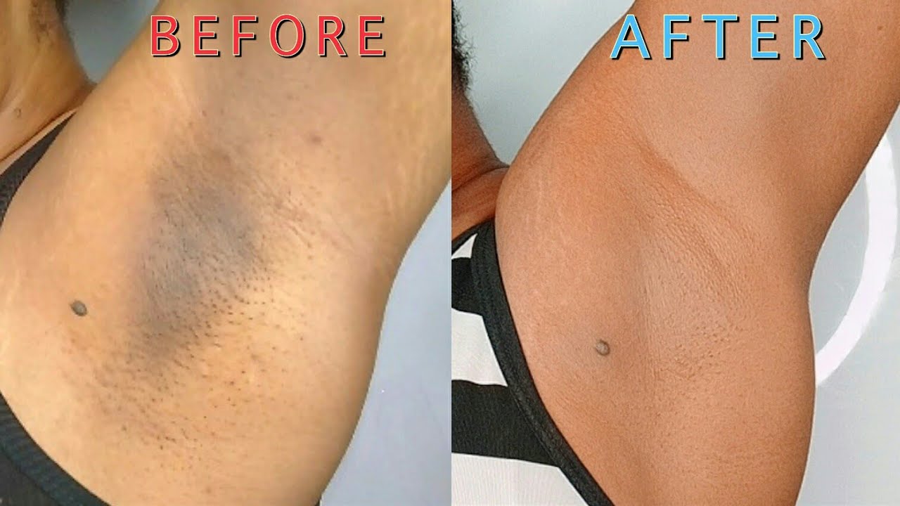 How To Lighten And Get Rid Of Dark Underarm| W/Just Two Product😲