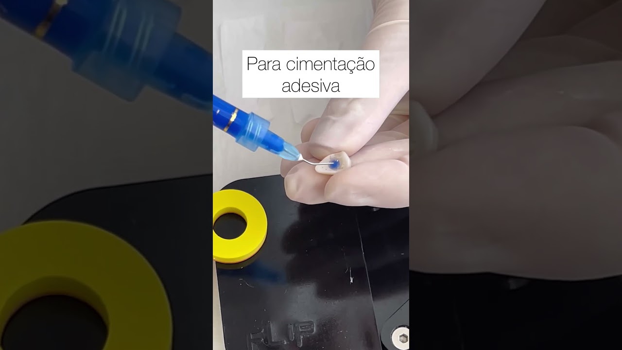 Cimenta&ccedil;&atilde;o adesiva 📍 #dentistas #odontologia #facetasdeporcelana #dentista #dentes