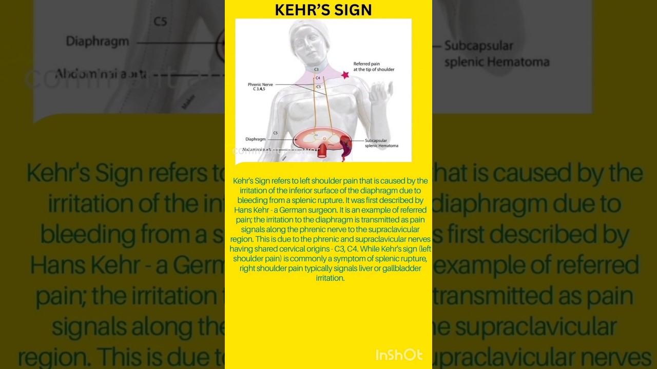KEHR's SIGN || SPLEEN RUPTURE #aiapgetpreparation #shorts #medicallectures
