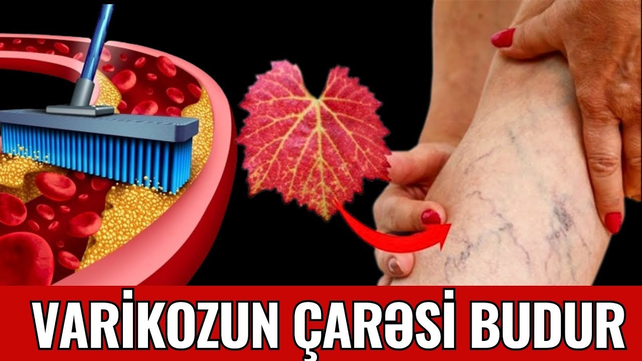 Ayaqlarda H&ouml;r&uuml;m&ccedil;ək Toruna bənzəyən Damarlar - Varikozun &Ccedil;arəsi Budur