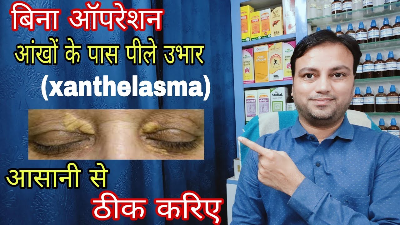 आंखों के किनारे पीले उभार 2 महीने में गायब करने वाला इलाज, best Homeopathic medicine for xanthelasma