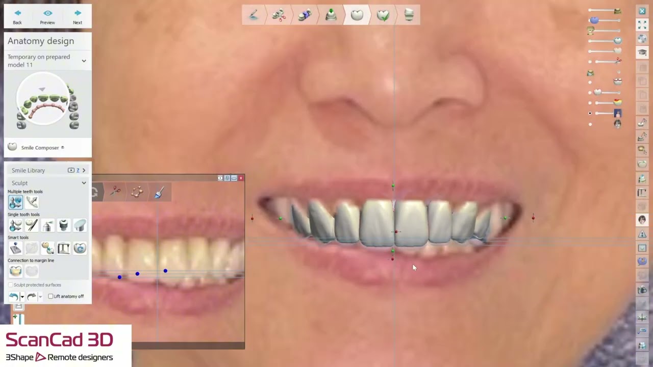 3shape waxup 02-20-2026 K