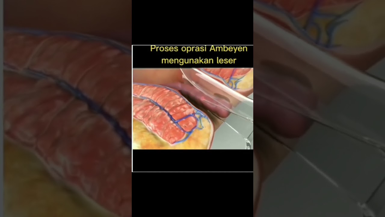 Proses Operasi Ambeien