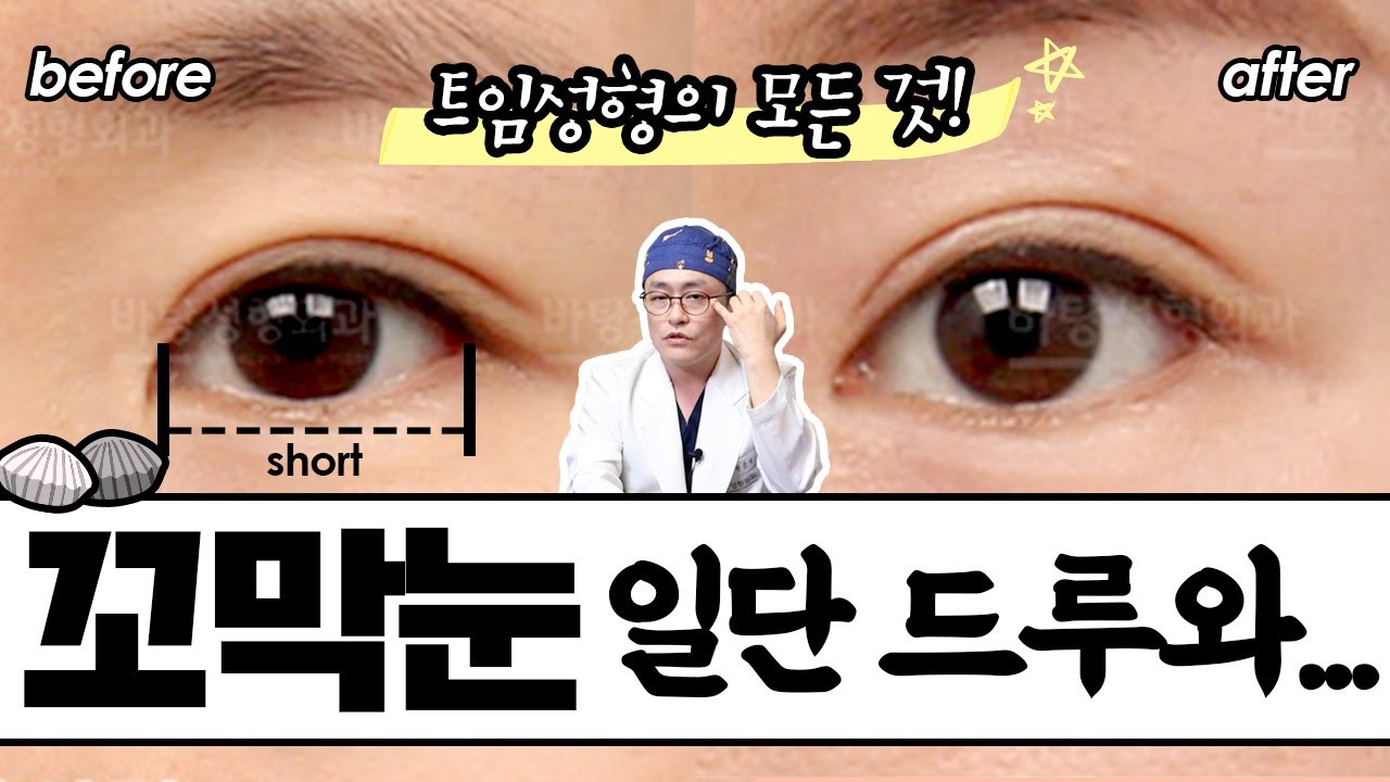 트임성형 실패할까 겁난다면 이 영상 필수 시청! #듀얼트임 #꼬막눈