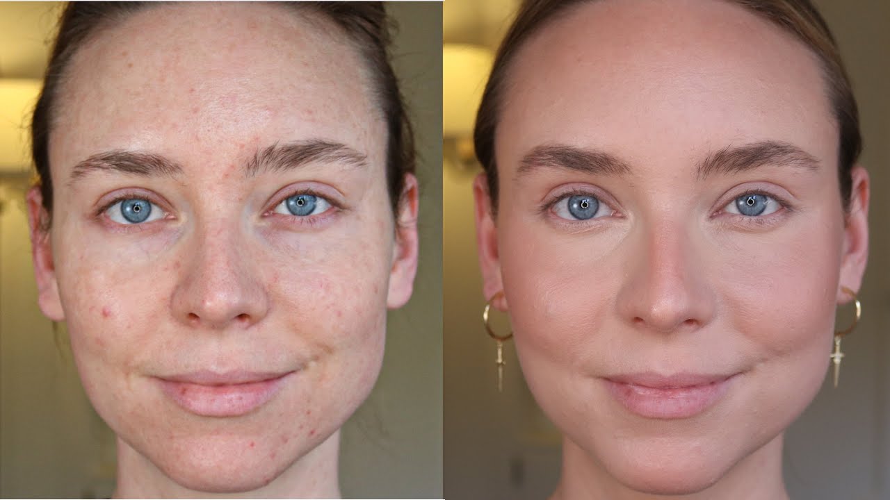 How I Cover Acne (Minimal Makeup Look)