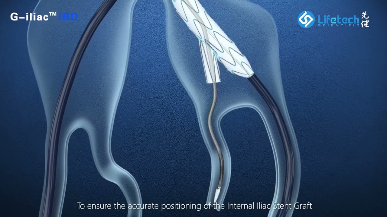 G-iliac IBD