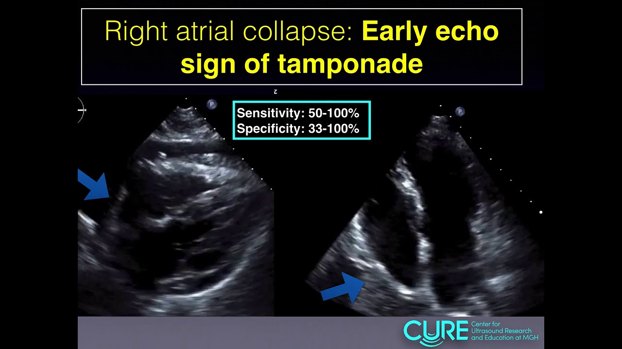 Pericardial Tamponade Echo