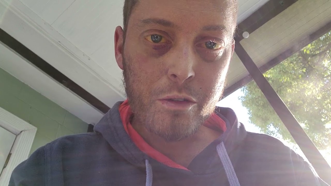 the days before transplant. meld score of 36!