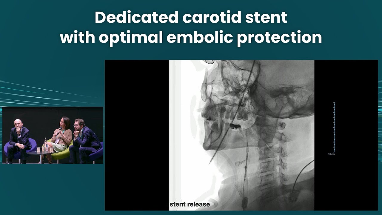 Dedicated carotid stent with optimal embolic protection - Best in class! - PVI 2024