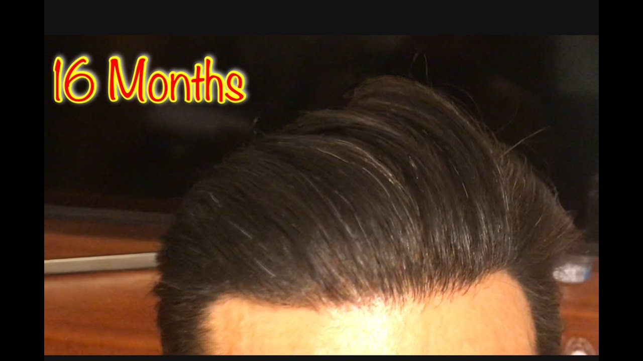 FUE Hair Transplant | 16 Months | Dermaroller | Hair Medical Restoration | HMR | Tijuana, Mexico FUE