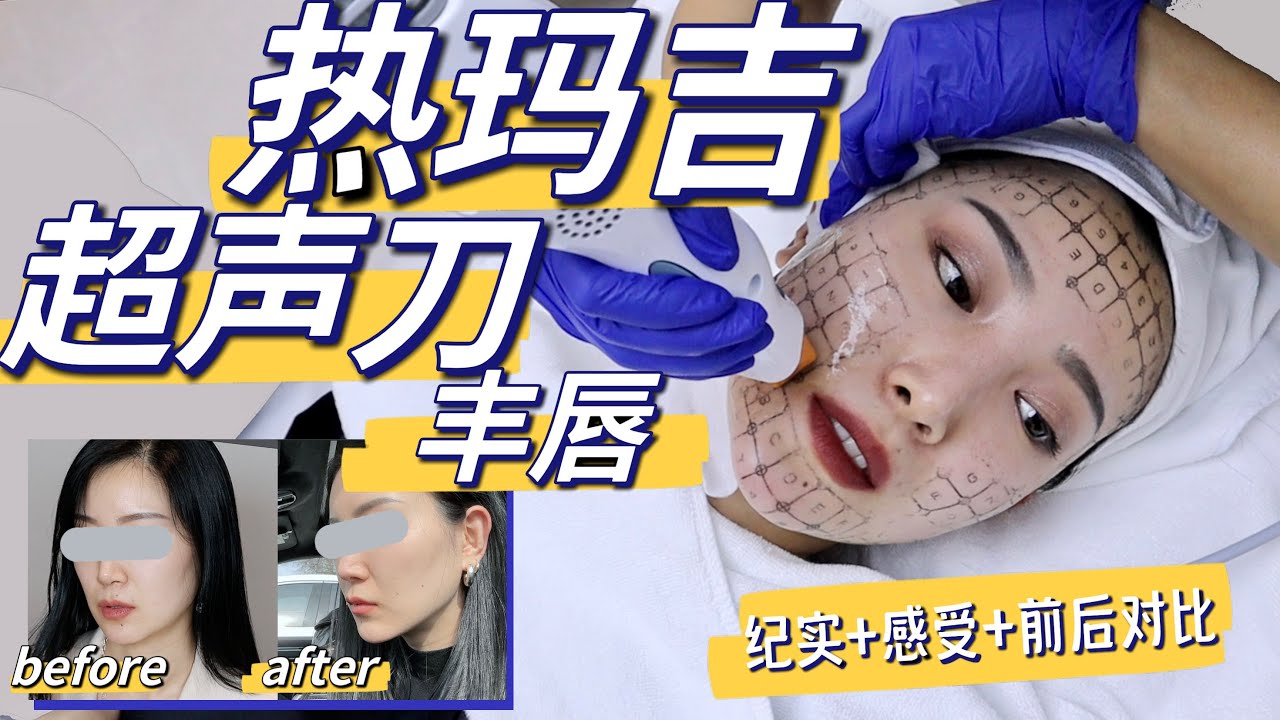 热玛吉/超声刀/丰唇｜2个月后真实感受｜值不值？多少钱？「ENG SUB」Ultherapy/Thermage/lip job Transformation After 2 Mo 这些人千万别做!