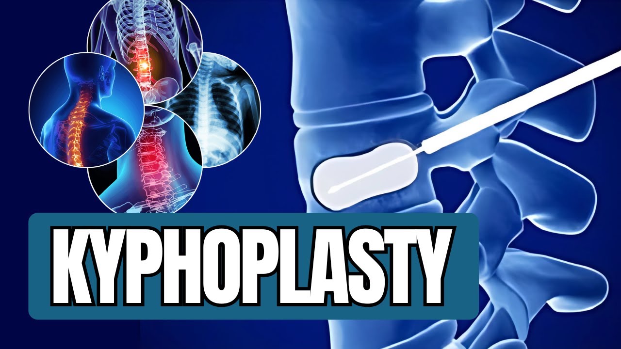 Kyphoplasty