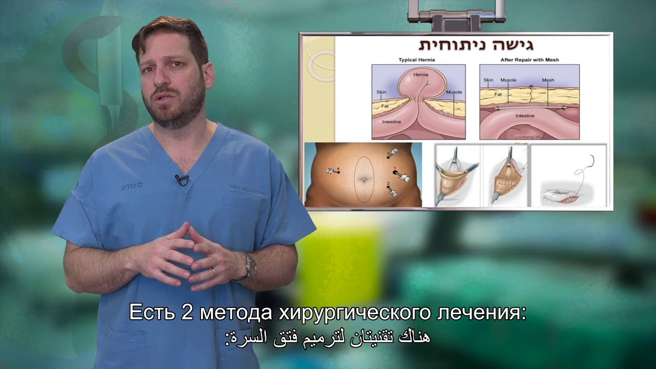 07 תיקון בקע טבורי   האיגוד הכירורגי של ההסתדרות הרפואית בישראל