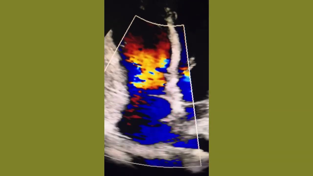 Tricuspid Valve Dysplasia (Adult Congenital Heart Disease)