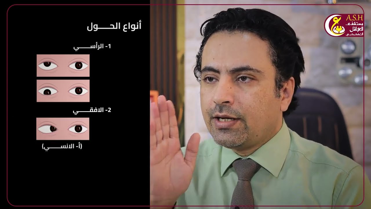 هل النظارات وحدها كافية لعلاج الحول؟ الفرق بين الحول والانحراف
