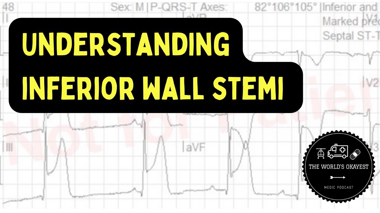 Understanding Inferior Wall MI for Paramedics (Explicit)