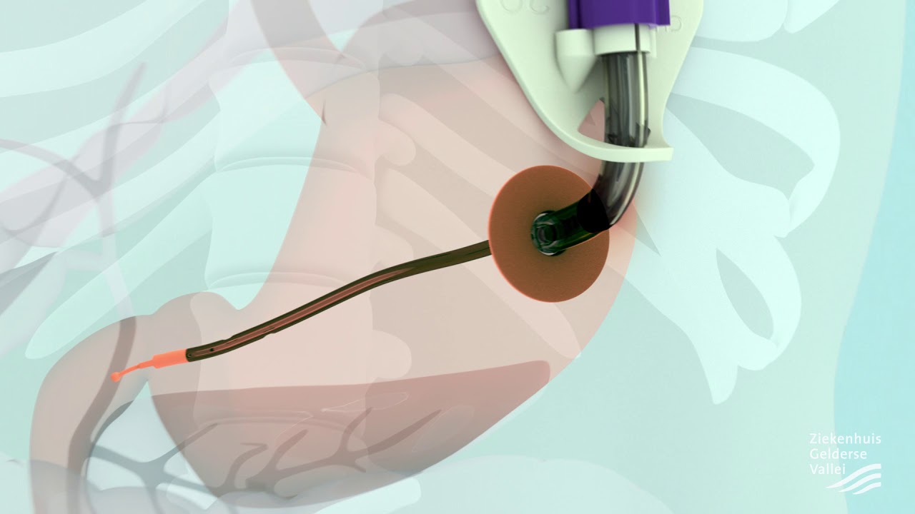 PEG-J sonde - Ziekenhuis Gelderse Vallei