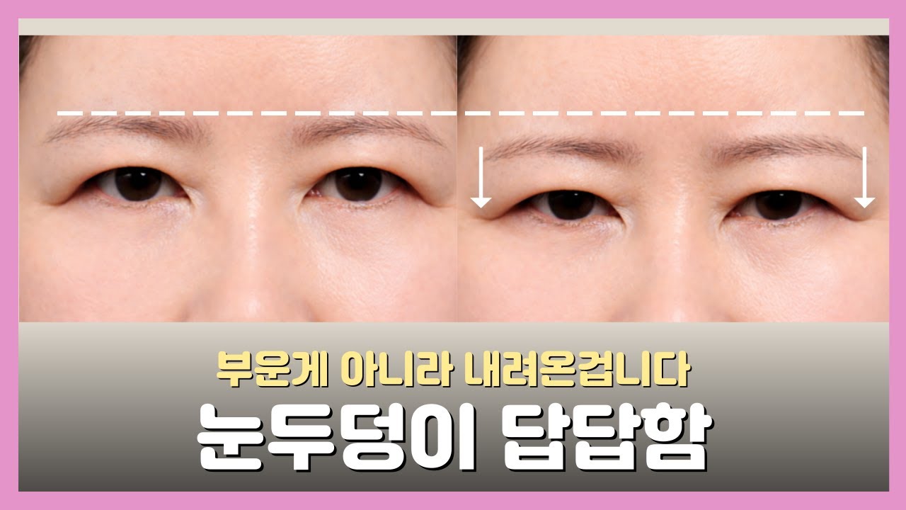 눈썹 아래 살이 많아진 것 같다면? 이 수술이 답