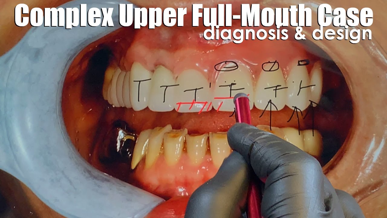 Complex Upper Full-Mouth Case Design & Diagnosis | Dental Lab Learning