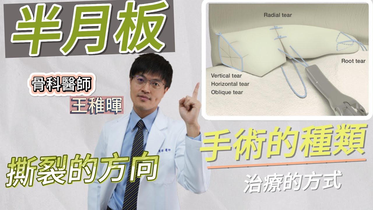 【半月板系列】半月板撕裂的方向｜手術的種類｜其他治療的方式｜王稚暉醫師
