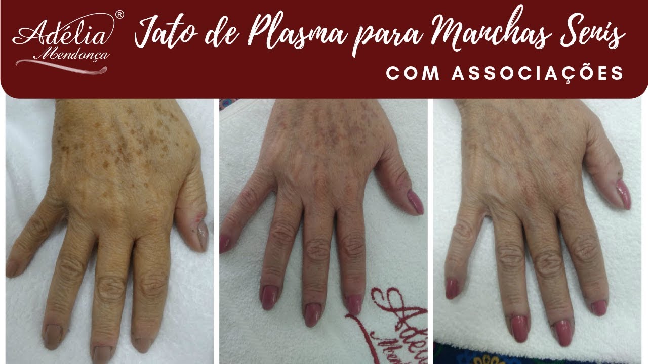 Protocolo Jato de Plasma para Mãos