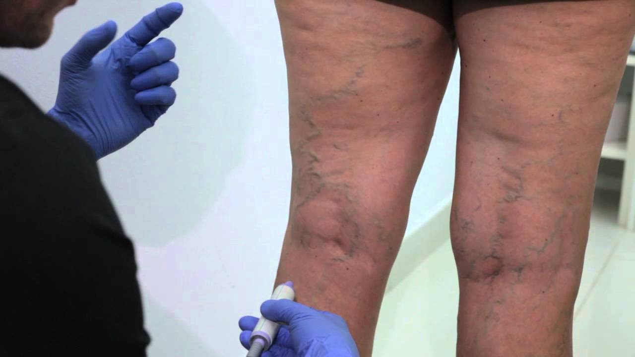 Tratamiento Cosmético de Varices