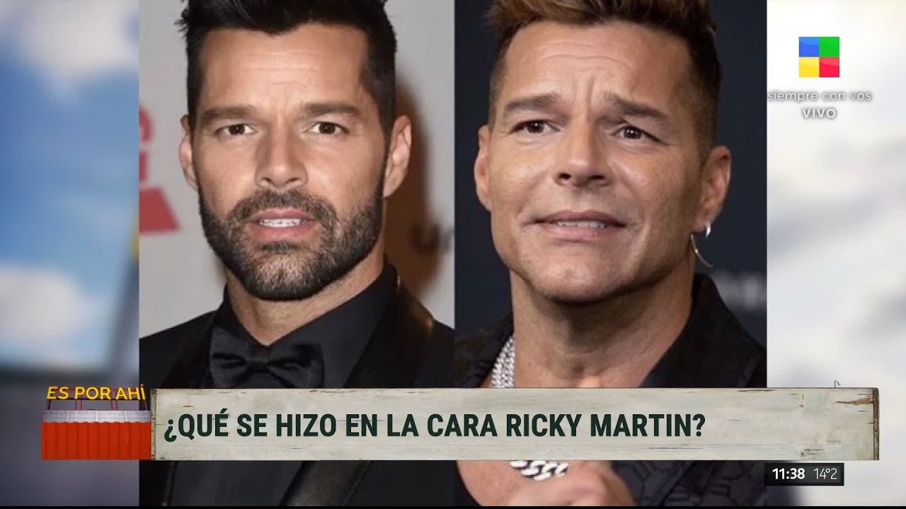 ¿Qué se hizo en la cara Ricky Martin?