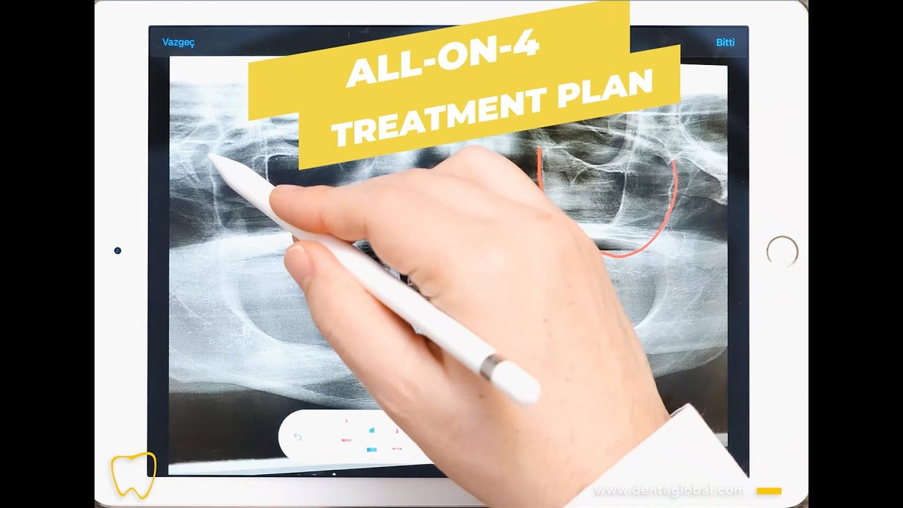 All-On-4 treatment is our strong suit. Let&rsquo;s have a look -why All-On-4 is the best option for you. 👍