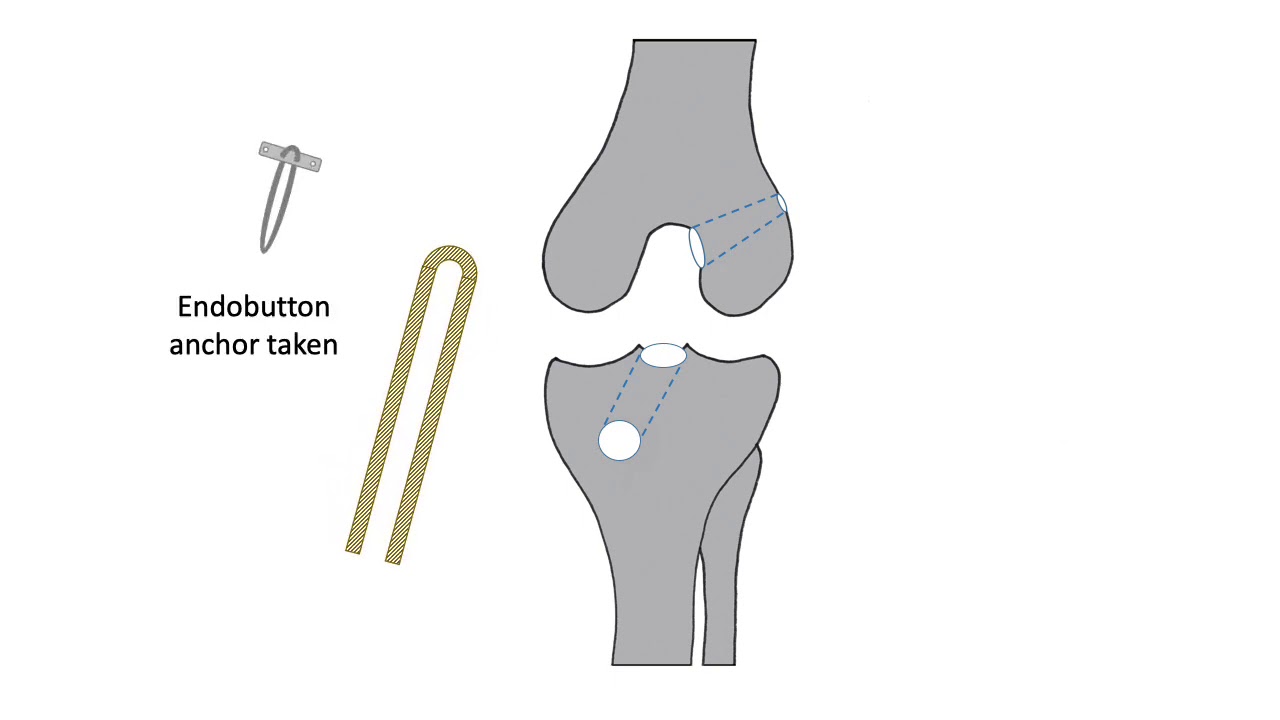 ACL reconstruction animation, by Mr Ian McDermott