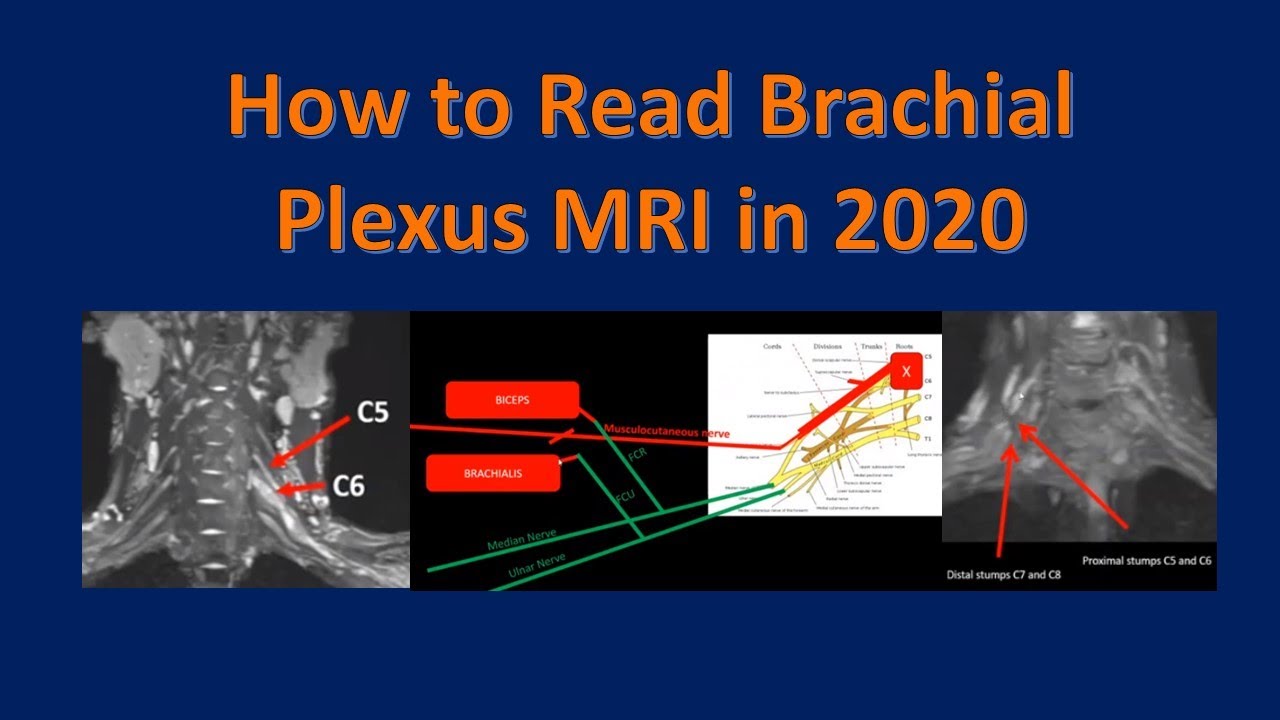 How to Read a Brachial Plexus MRI in the Setting of Trauma (2020 Update)