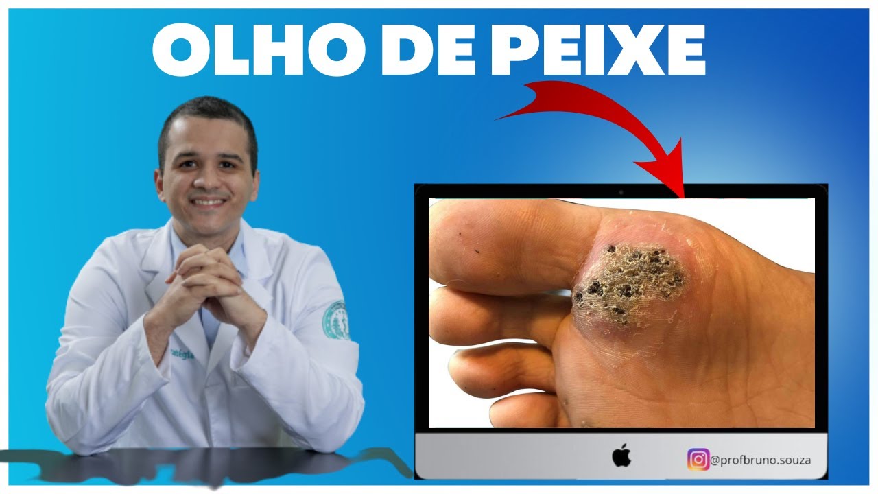Verruga Plantar (Olho de Peixe): Causas, Tratamentos e Prevenção | Guia Completo
