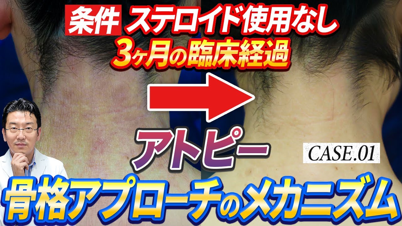 【症例解説】なぜ「骨格」でアトピー肌が変化したのか？薬物治療を行わない条件での3ヶ月・臨床研究データ