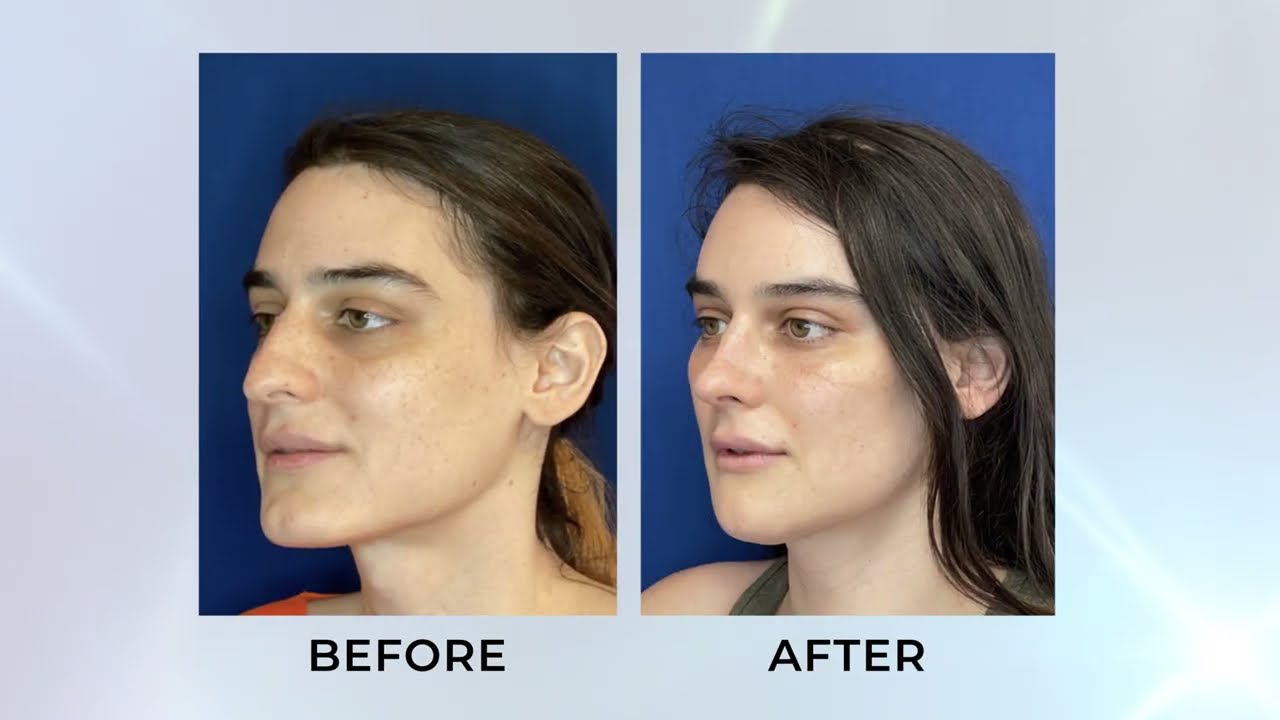 Facial Feminization Surgery with Dr. Pang | Align Surgical Associates