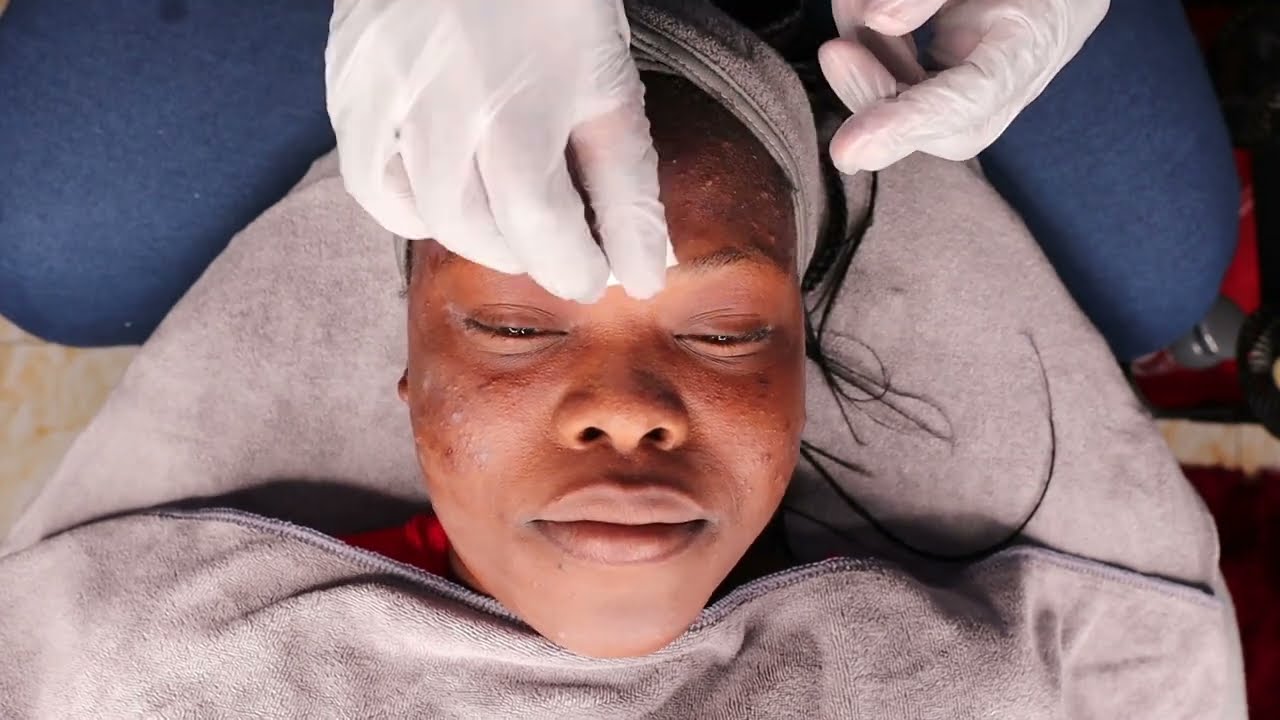 MY ACNE SOLUTION- HOW TO DO CHEMICAL PEEL METHOD