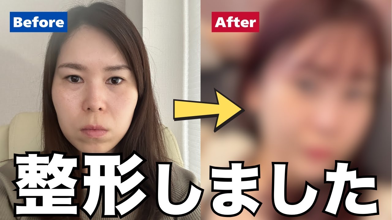 整形総額1200万円のビフォーアフター全部見せちゃいます！