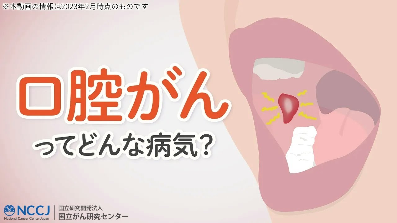 【口腔がん】どんな病気？毎日のセルフチェックで早期発見の可能性も！