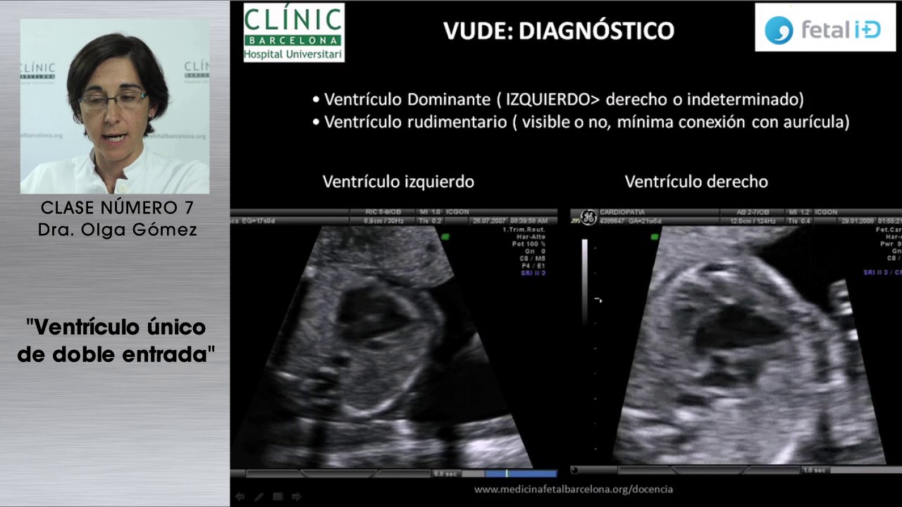 VENTRICULO UNICO DE DOBLE ENTRADA