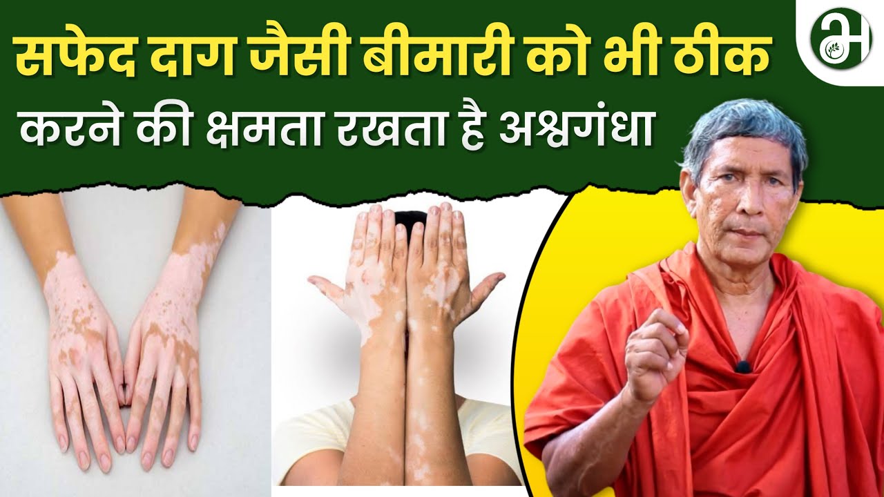 सफ़ेद दाग (LEUCODERMA AND VITILIGO), वजन बढ़ाने और कफ़ रोगों को जड़ से खत्म करने का दम रखता है अश्वगंधा
