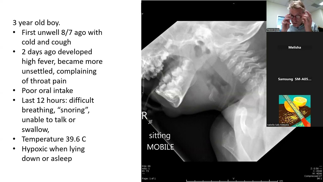 2025 13 Upper airway obstruction in infants and children