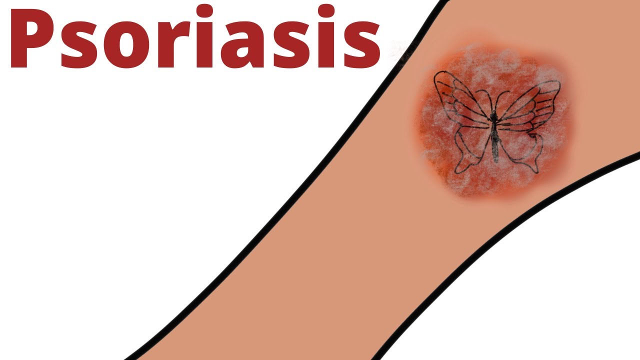 What is Psoriasis? - Pathology mini tutorials