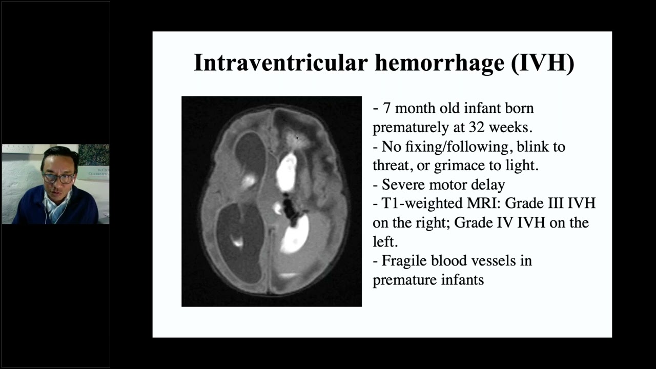 CVI Webinar Expert Panel from Pediatric Ophthalmology and Neuro-Ophthalmology and Parent Perspective